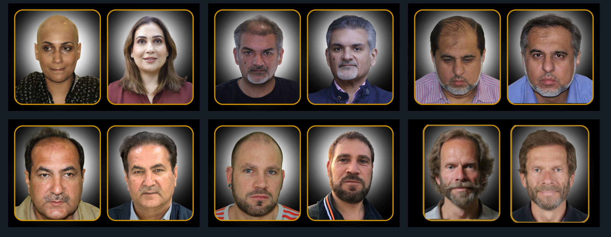 After Hair Restoration Result